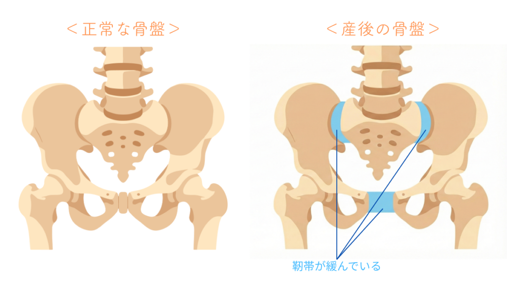 正常な骨盤と、靭帯が緩んで開いている産後の骨盤の比較イラスト図解