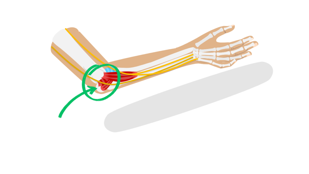 肘の内側の骨と筋肉の解剖図。緑の丸と矢印で、ゴルフ肘で炎症が起きやすい上腕骨内側上顆の部分を指し示している。